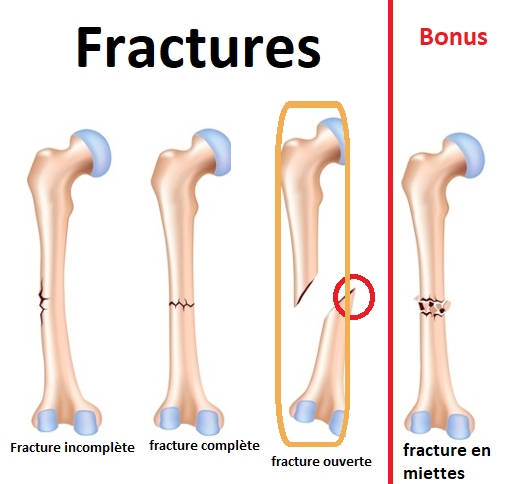 C2T / MLB Tech  Les blessures et les Fractures